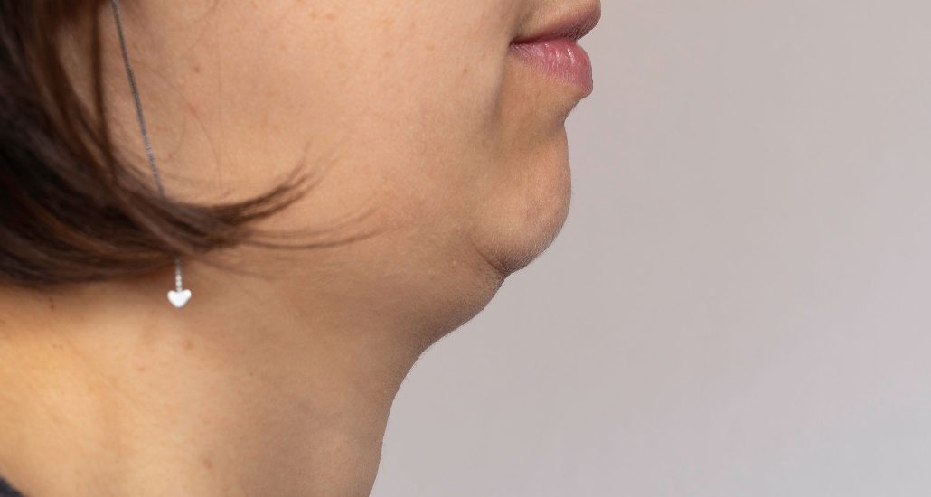 Chin exercises receding Receding Chin: