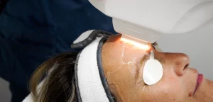 IPL Therapy Treatment for Vibrant and Glowing Skin