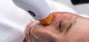 Thermage CPT a Radiofrequency Therapy Treatment for Younger Looking Skin