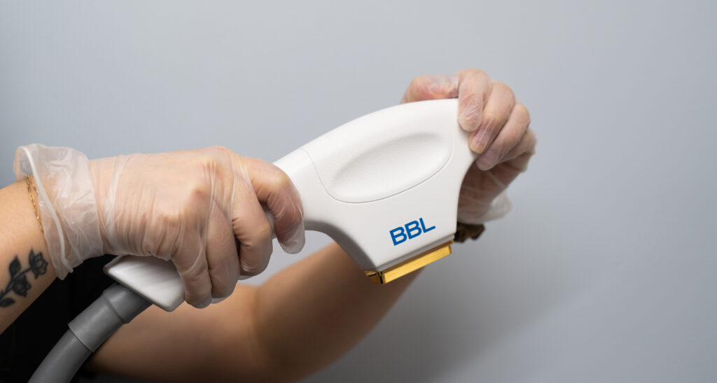 BBL-HandPiece -laser treatment for redness and pigment