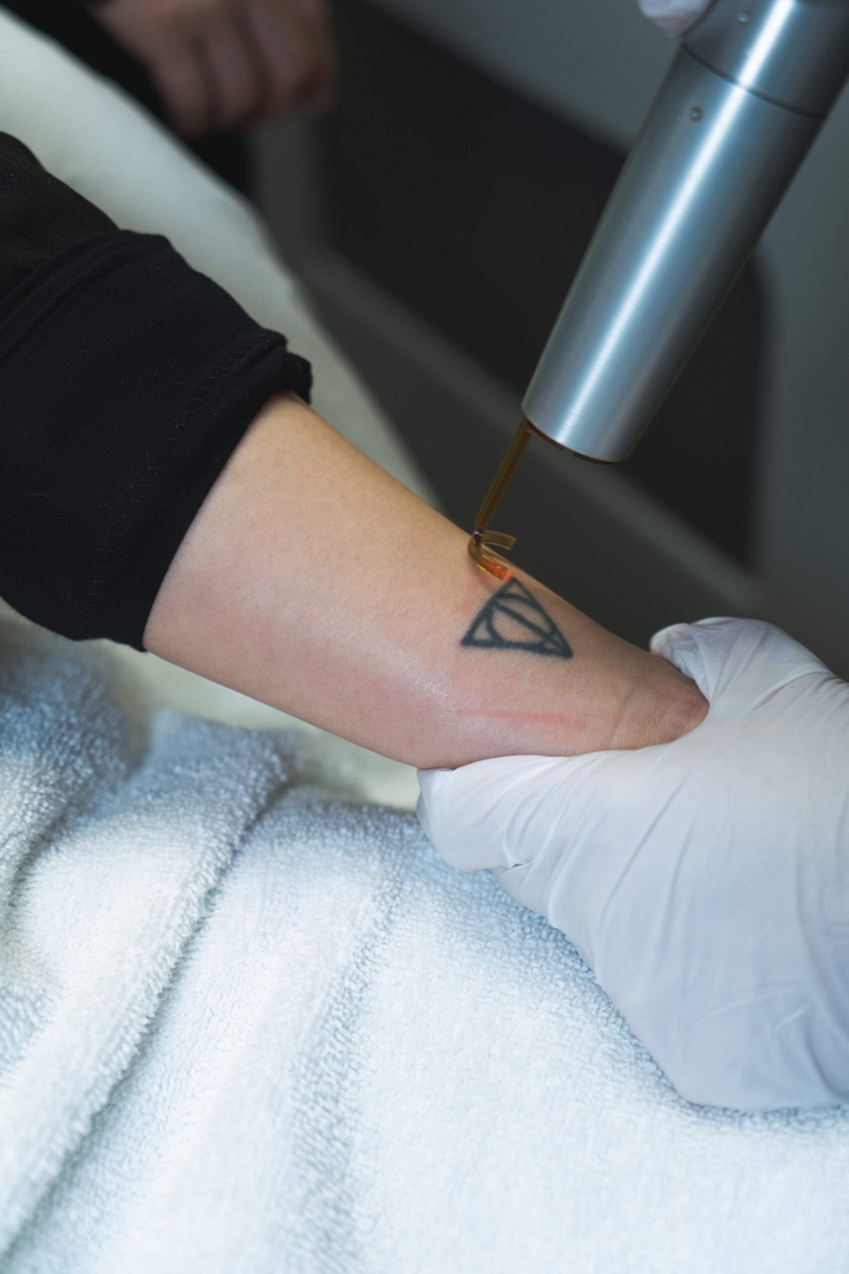 How Long Does Laser Tattoo Removal Take? | Bala Aesthetics
