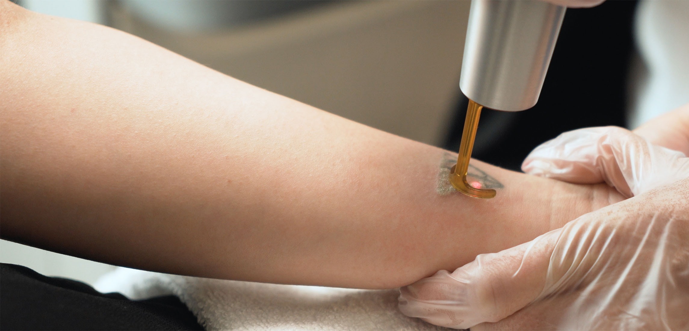 Laser Tattoo Removal In San Diego | La Jolla Cosmetic Laser Clinic