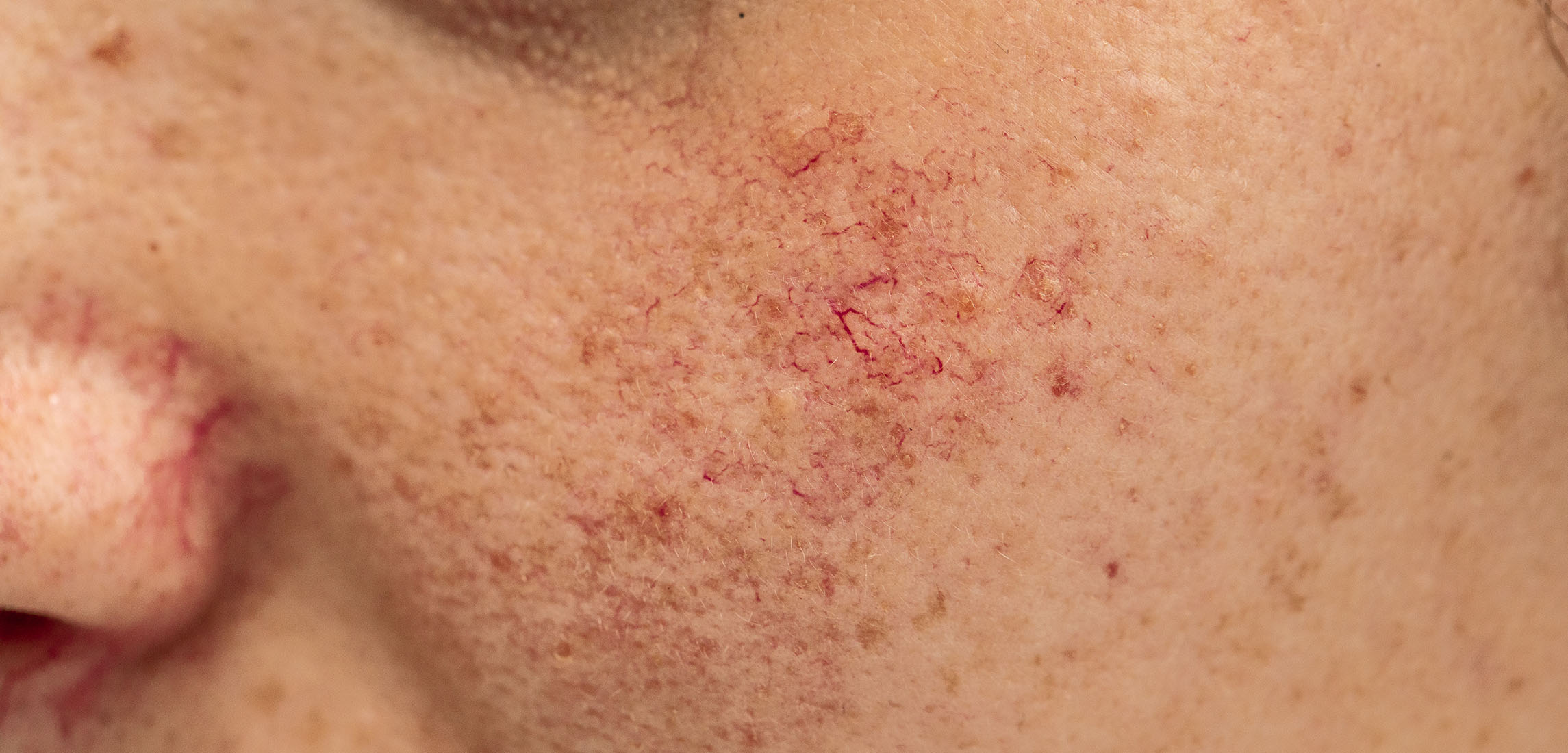 Broken Capillaries Causes Treatment Options In Vancouver