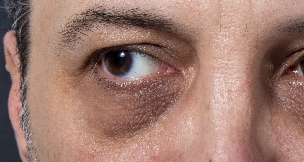 Dark circles under the eyes: Causes, treatment options, and more