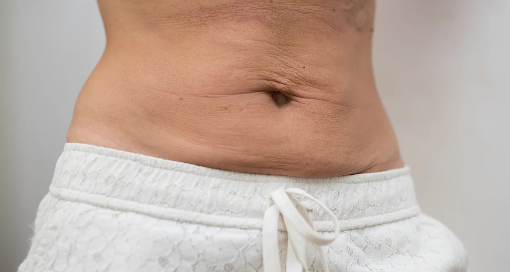 How To Tighten Tummy Skin?  