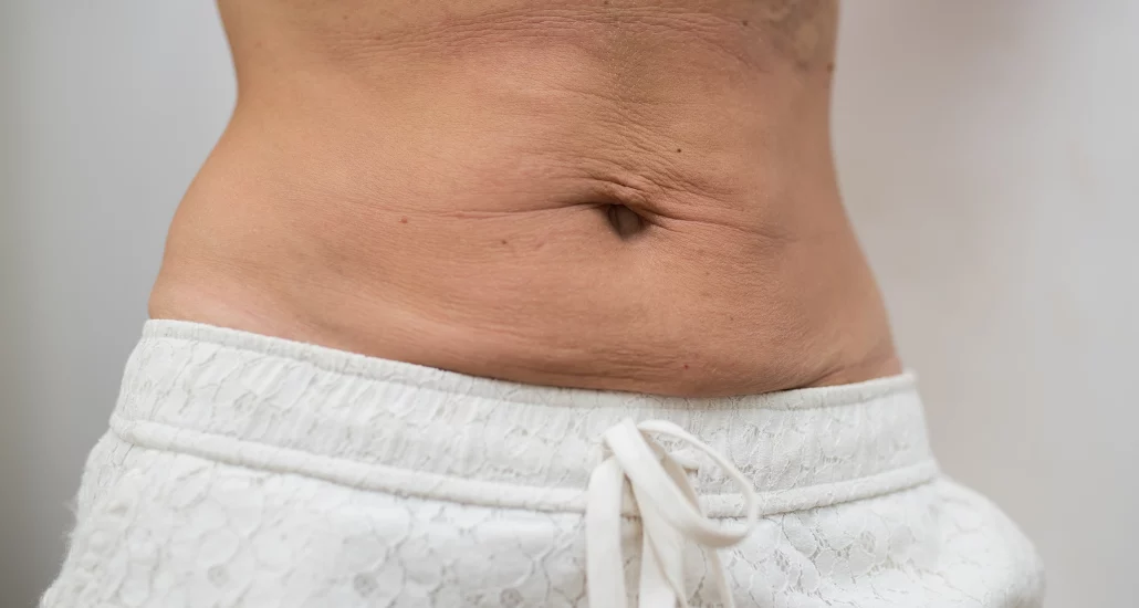 Does Nonsurgical Skin Tightening Work on Loose Skin Around the Waist?