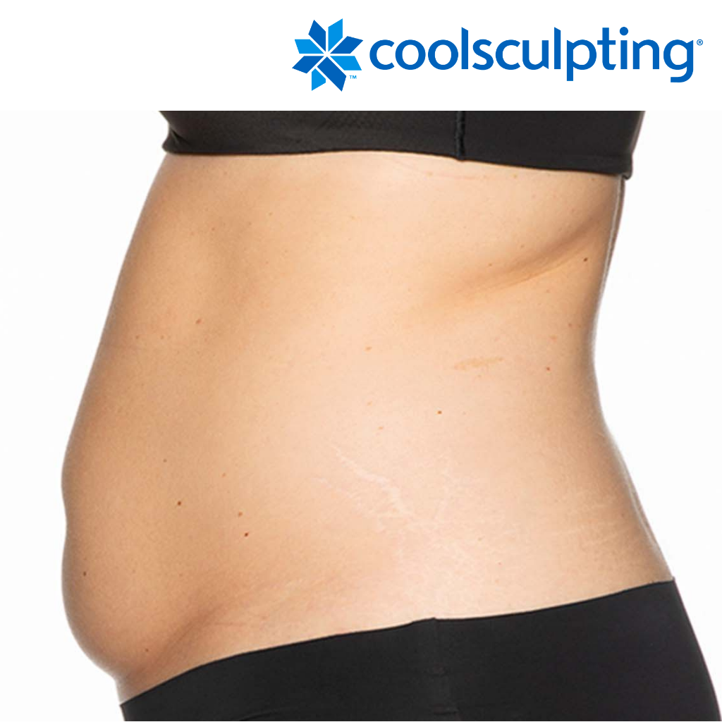 CoolSculpting® For Men Vancouver  Body Sculpting For Men Yaletown