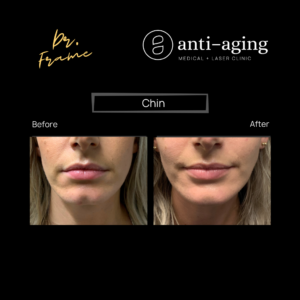 Filler chin volume- before after