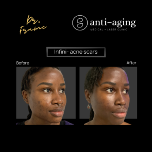 Infini RF microneedling- before after
