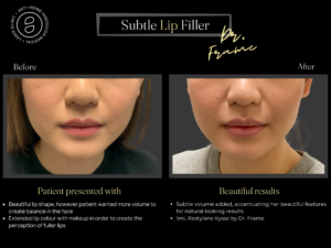 Subtle Lip Filler- Before after