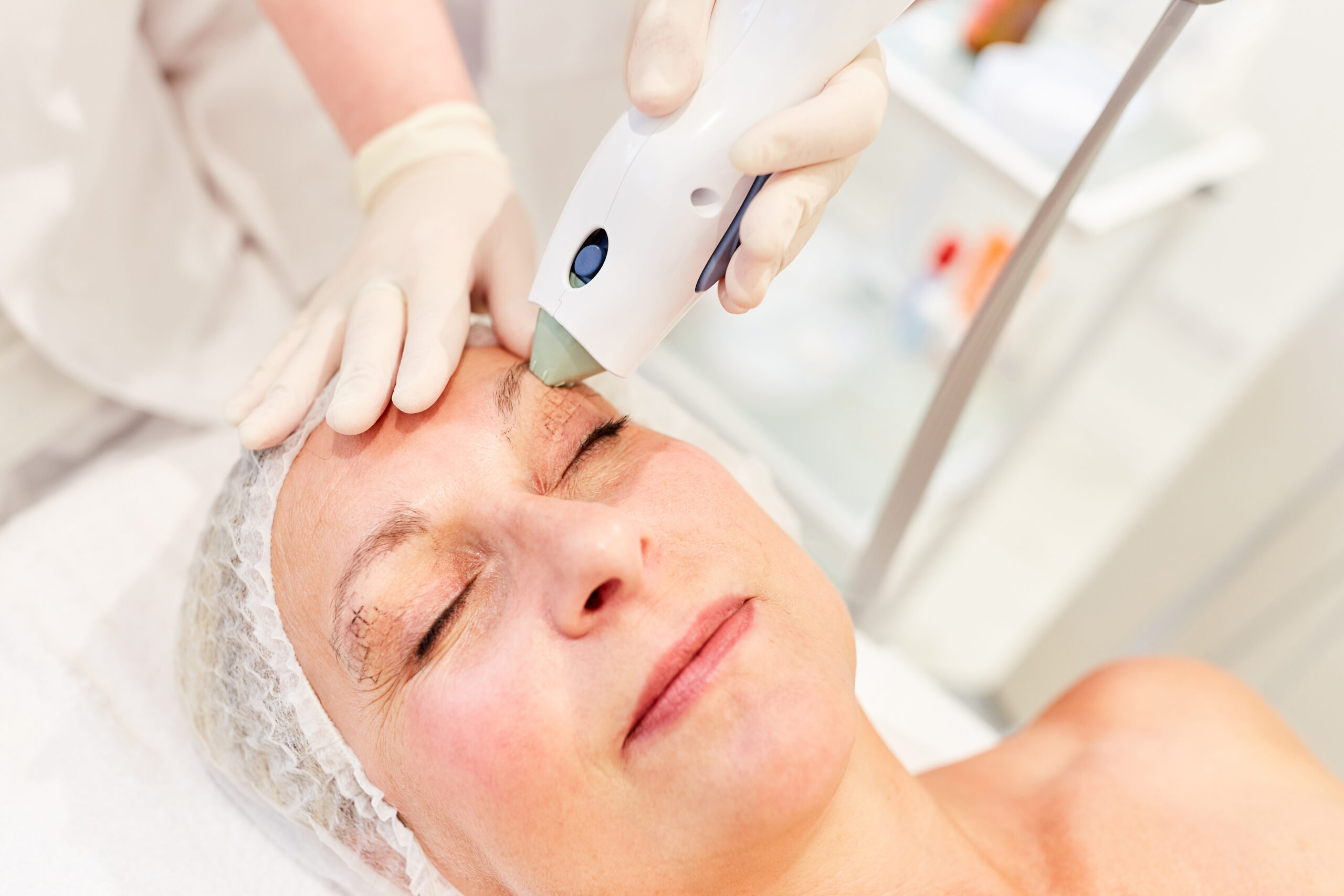 Anti-Aging Skin tightening: what it is and what treatment options