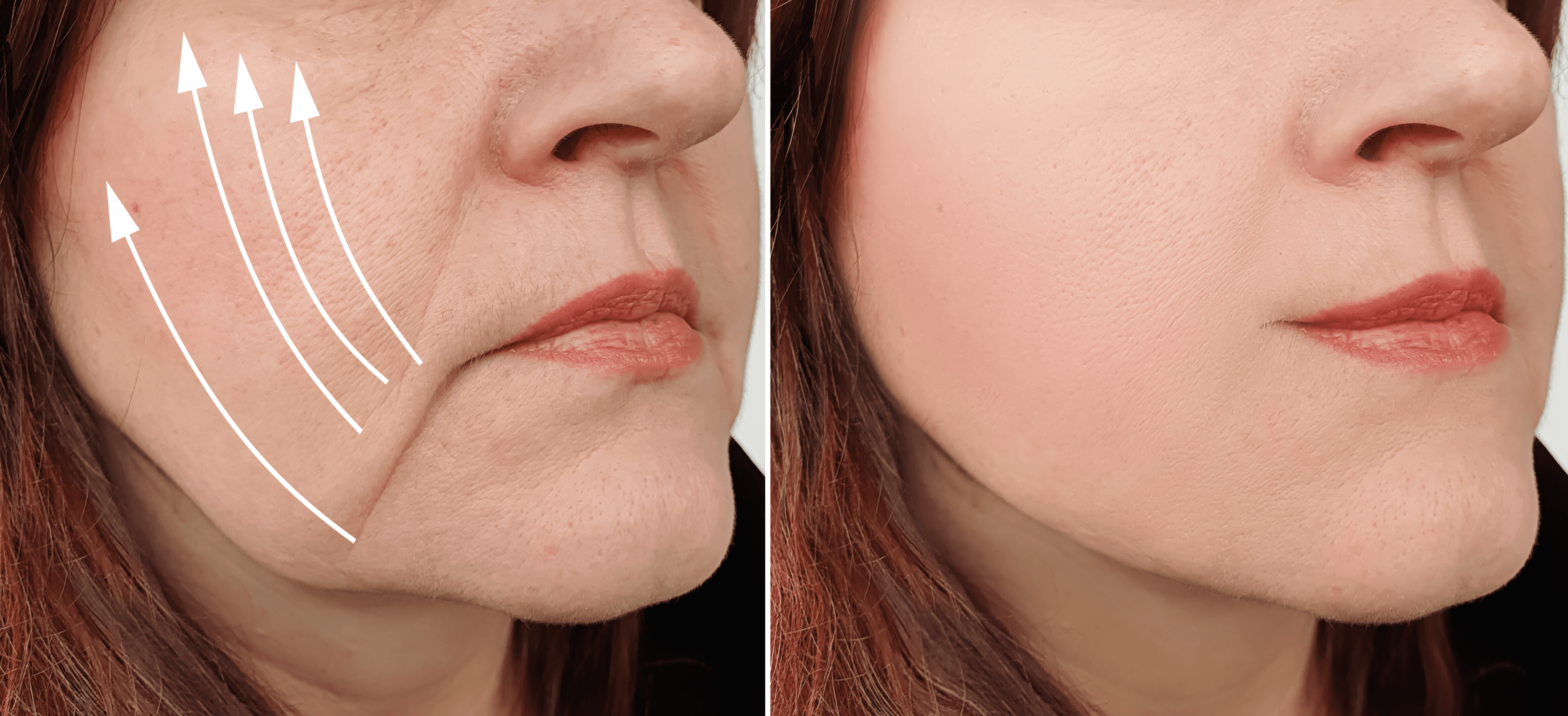 Treatments for Droopy Cheeks  Anti-aging Medical & Laser Clinic