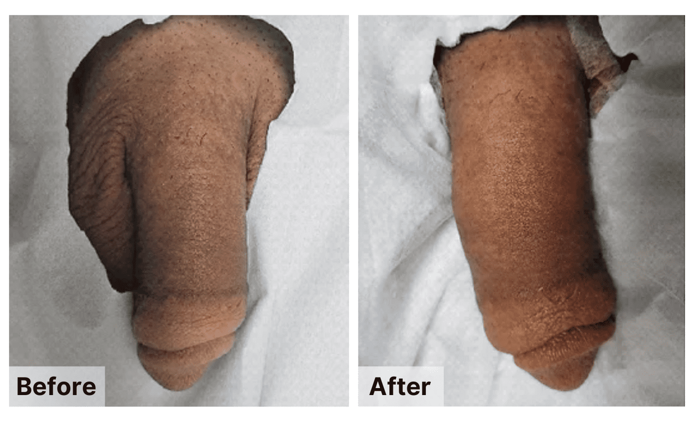 Penis Enlargement Surgery: Length & Girth Enhancement